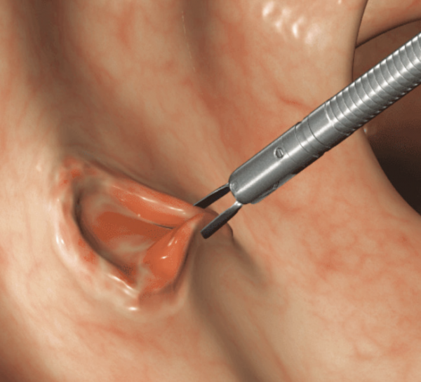 DuraClip® Repositionable Hemostasis Clips
