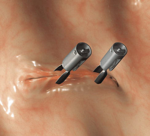 DuraClip® Repositionable Hemostasis Clips